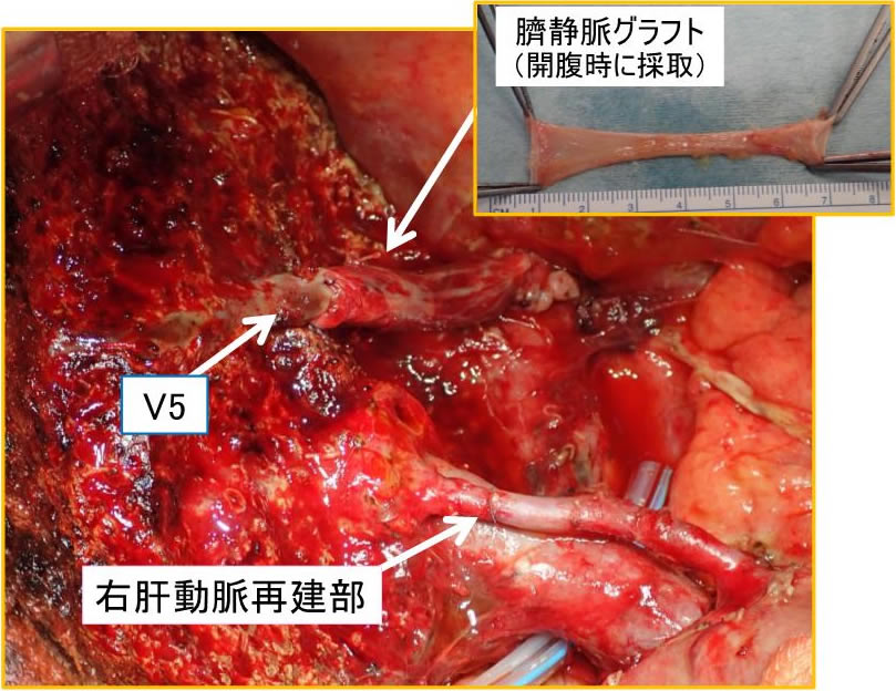 図2．肝動脈・肝静脈合併切除再建を伴う肝切除術イメージ