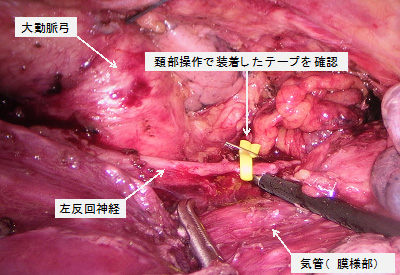 胸腔鏡操作での左反回神経周囲郭清イメージ