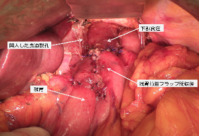 下部食道噴門側胃切除術 観音開き法再建イメージ