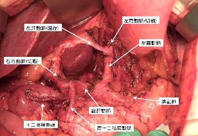 左肝動脈が左胃動脈から分枝する症例に対する郭清イメージ