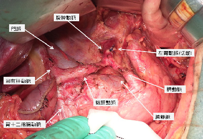 腹腔動脈周囲リンパ節転移症例に対する徹底郭清イメージ