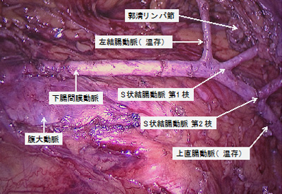 左結腸動脈、上直腸動脈を温存した郭清イメージ