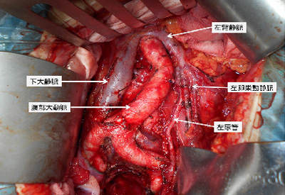 大動脈周囲リンパ節転移症例に対する徹底郭清イメージ
