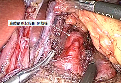 腹腔鏡下正中弓状靱帯切除術イメージ