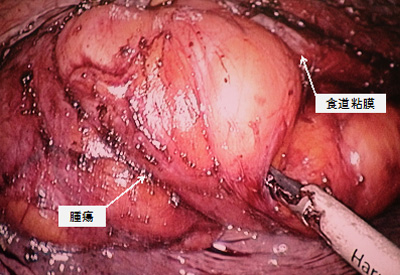 胸腔鏡下食道脂肪腫核出術イメージ
