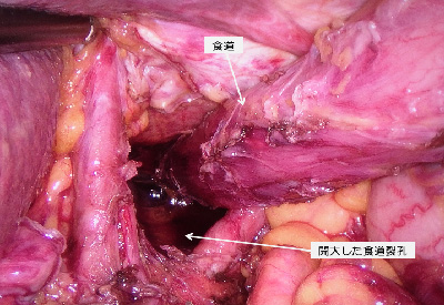 食道裂孔ヘルニアに対する腹腔鏡下手術イメージ
