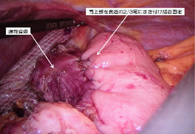 逆流性食道炎に対する腹腔鏡下Toupet手術イメージ