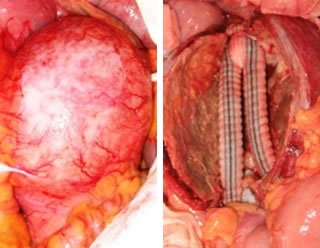 腹部大動脈瘤に対する人工血管置換術イメージ