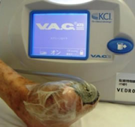 VACシステムによる創傷管理イメージ