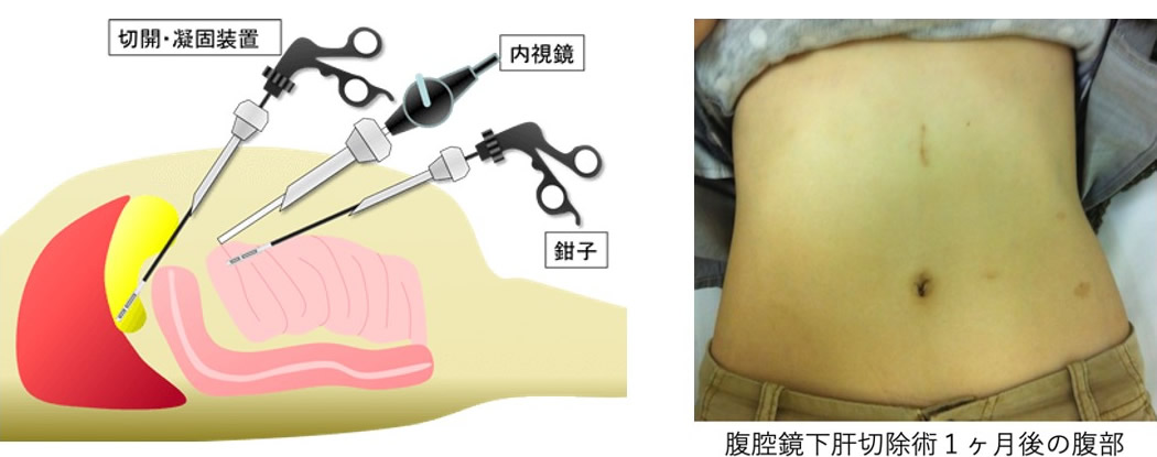 図3．腹腔鏡下肝切除術のイメージ図