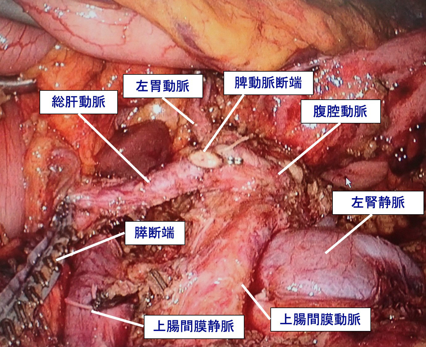 図5．膵癌に対する腹腔鏡下膵体尾部切除術イメージ