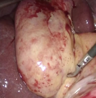 急性胆のう炎の手術イメージ
