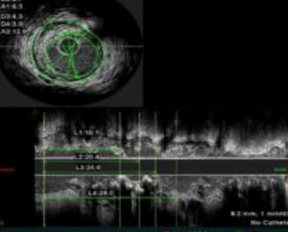 血管内超音波画像診断装置解析画像
