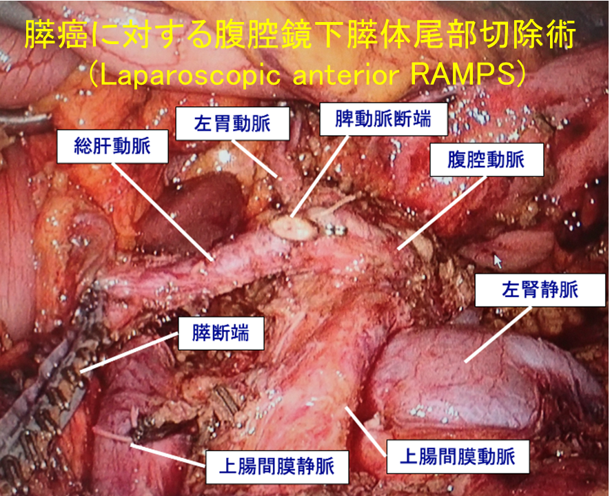 図5.膵癌に対する腹腔鏡下膵体尾部切除術イメージ