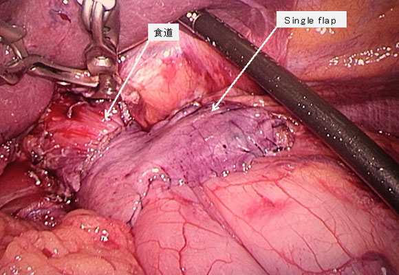 下部食道噴門側胃切除術 Single flap法再建イメージ