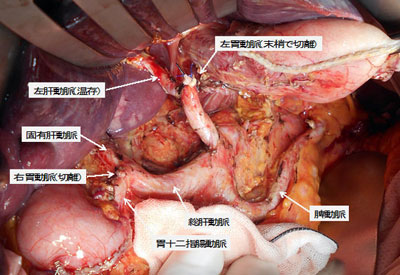 左肝動脈が左胃動脈から分枝する症例に対する郭清イメージ
