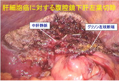 図4．年度別腹腔鏡下肝切除術症例数の推移イメージ