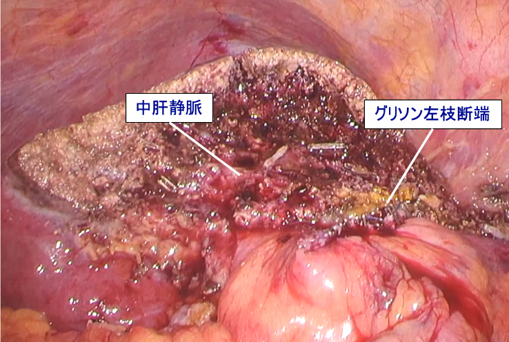 図3.腹腔鏡下肝左葉切除術後の状態