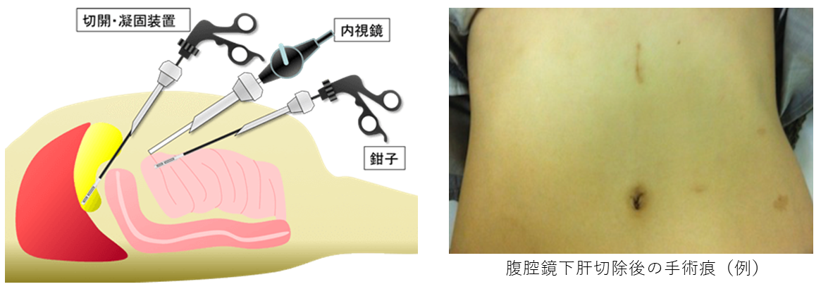 図1.腹腔鏡下肝切除術のイメージ