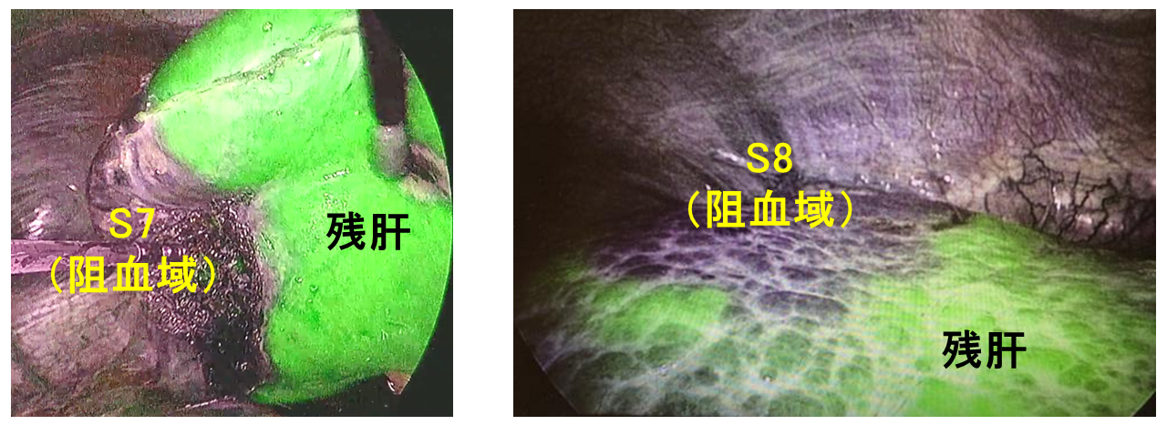 図4.肝切除の工夫 ICG negative stainingによる切除領域(阻血域)の描出